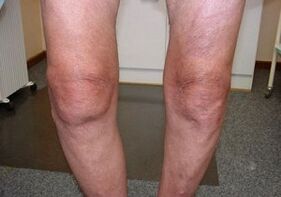 wie man Arthrose des Kniegelenks behandelt