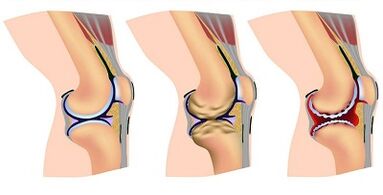 Entwicklungsstadien der Arthrose des Kniegelenks