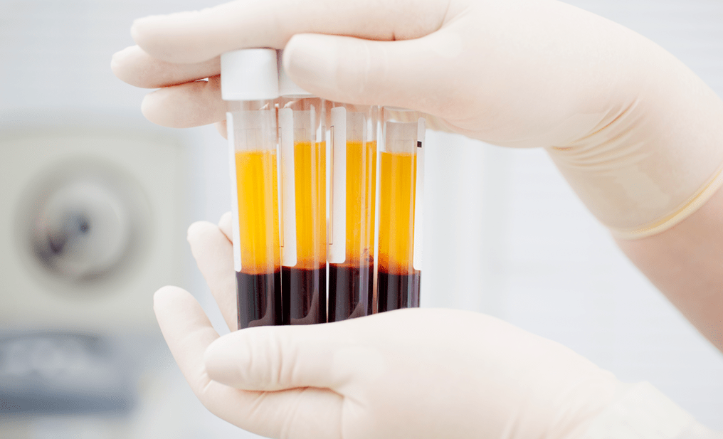 Plättchenreiches Plasma zur PRP-Therapie bei Arthrose